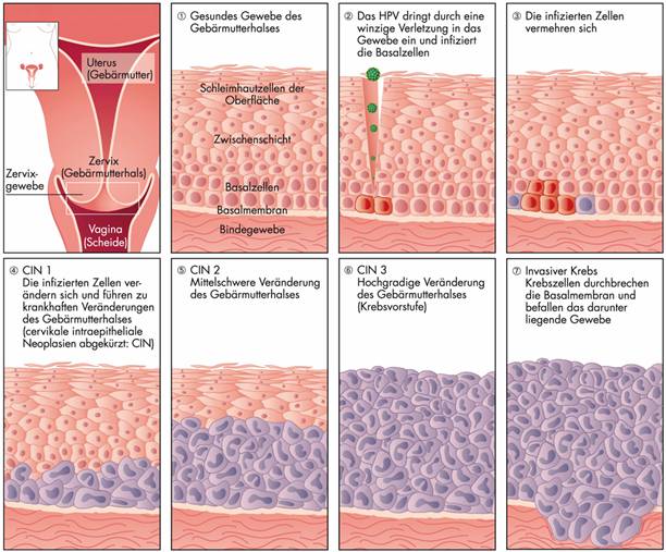 hpv viren gebarmutterhals